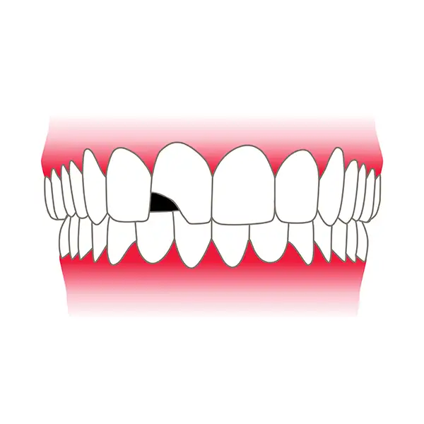 Upper and lower teeth with a large and noticeable chip missing from one of the upper front teeth.