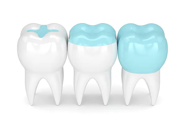 dental crowns inlays onlays