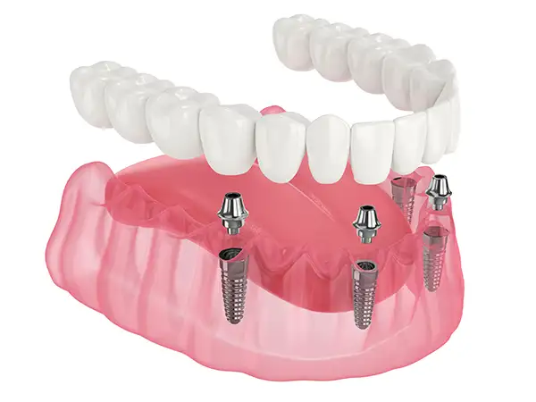 The implant-supported denture procedure, showing dental implants securing a full set of artificial teeth.