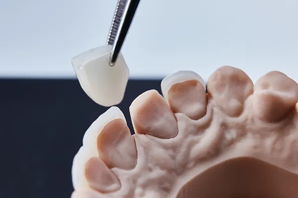 Close-up of a dentist applying Lumineer dental veneers to a detailed dental model, showing how the Lumineers sits on the teeth.