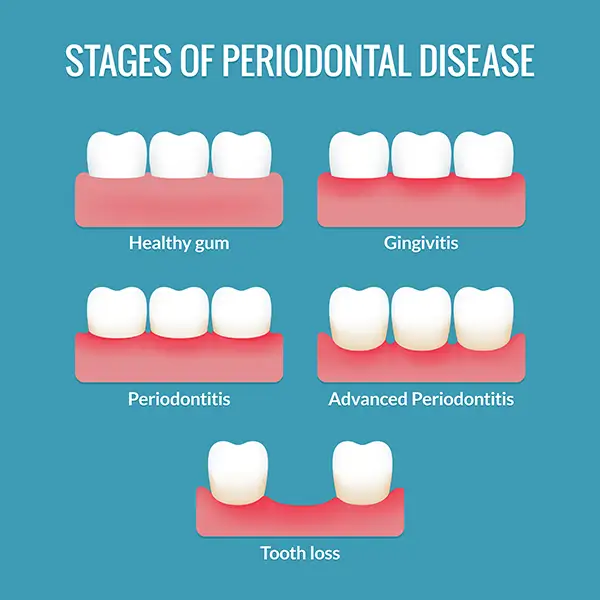 Diagram outlining the stages of periodontal disease and their symptoms, from healthy gums to gingivitis, periodontitis, and tooth loss.